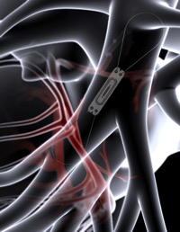 CardioMEMS